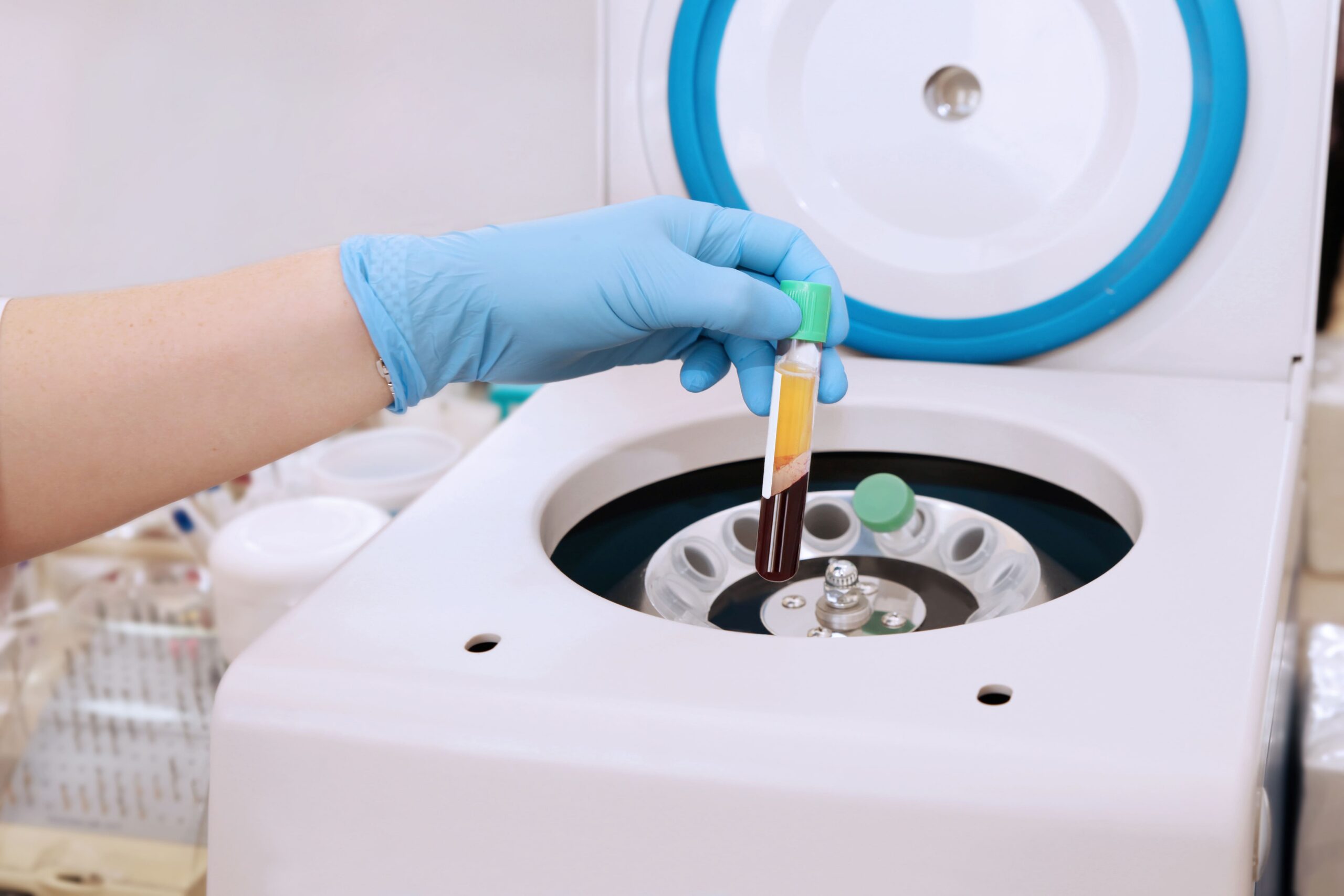 PRP Therapy